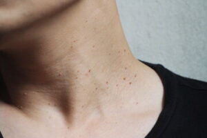 Skin Tags